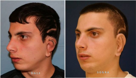 Annenin kaburgasından oğluna kulak