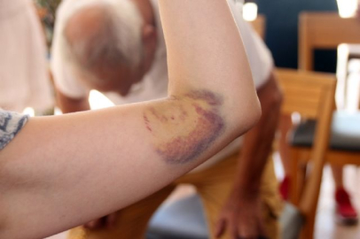 Japon heyete caretta caretta saldırdı