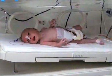 Karnından 1 kilo 300 gram kitle çıkarıldı