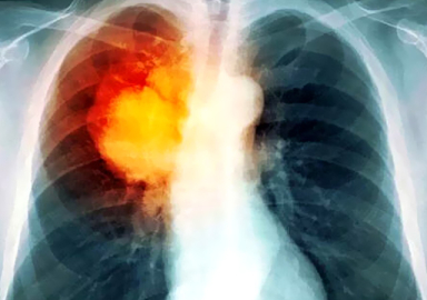 Bacaklarda şişme ve ağrı belirtilerine dikkat!