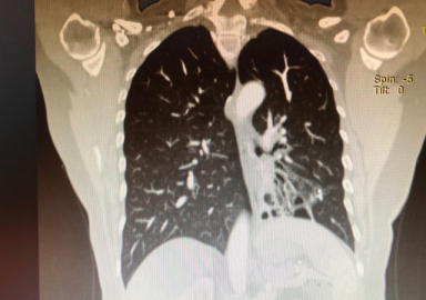 Tekrarlayan ve geçmeyen öksürük: Bronşektazi