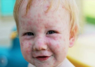 Kelebek hastalığı (Epidermolizis Bülloza) nedir? Kelebek hastası Elfida'ya sürpriz!