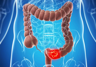 Uzun zaman oturmak bağırsak kanserine risk oluşturuyor