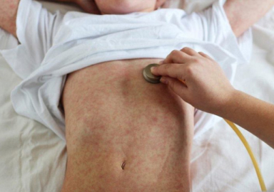 ABD'de kızamık görülen eyalet sayısı 28'e çıktı