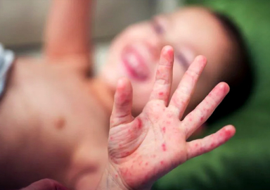 Kızamıkta sonbahar alarmı! Bakan Koca'dan iddialara yanıt