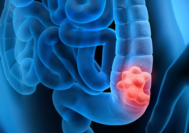 Genç yaşta bağırsak kanseri alarmı: Küresel artış endişe veriyor