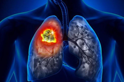 Beslenme şekli, akciğer kanseri riskini etkiliyor mu? Yeni araştırma şaşırttı