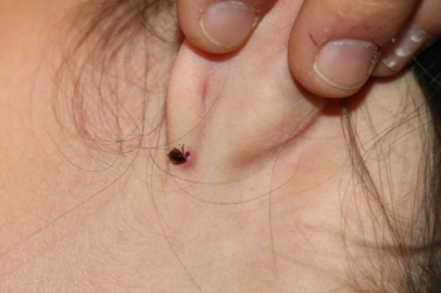 İstanbul'da 3 ayda 6 bini aşkın kene vakası