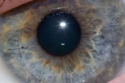 Gözleri görmeyen hastaya tarihi operasyon