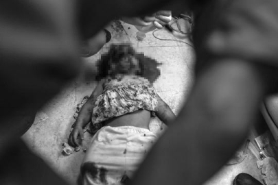 Katil İsrail’in saldırıları Gazze’de hastaneleri çökertti: Doktorlar ameliyatları anestezisiz yapıyor