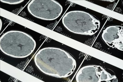 Uzmanlardan masajla gelen inme uyarısı