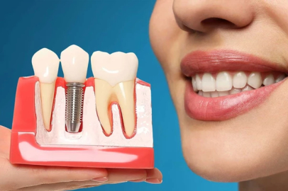 Milyonları ilgilendiriyor! İmplant SSK kapsamına giriyor